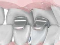 Núm chặn nâng khớp